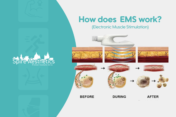 EMS treatment for post pregnancy weight loss treatment Harlow
