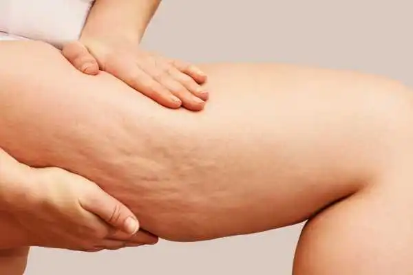 Image of woman showing leg with cellulite Harlow