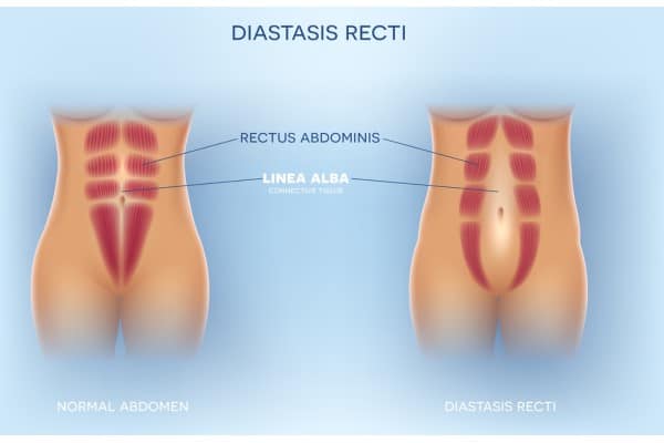 What Non-Surgical Options Are Available for Diastasis Recti Harlow?