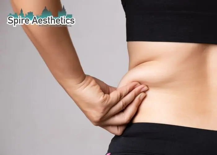 Image of woman pinching fat on their hips Harlow. Fat Freezing treatment