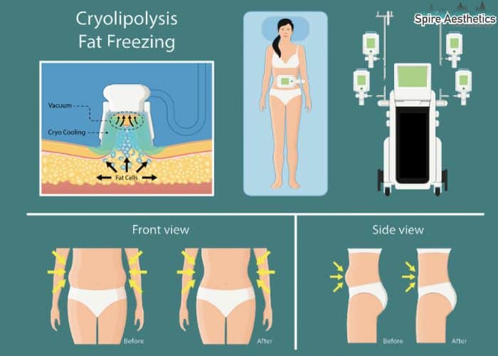 Image of diet and fat freezing combined for best results for Spire Aesthetics Harlow