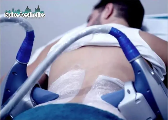 Man having fat freezing treatment done on love handles before a competitions Harlow to create a sculpted look.