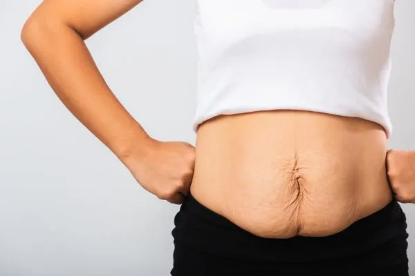 Image of a woman's stomach after weight loss with sagging skin following a gastric band Harlow