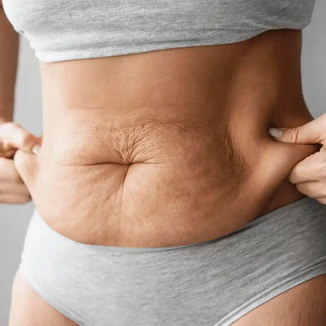 Is It Normal to Have Loose Skin After Pregnancy Harlow?