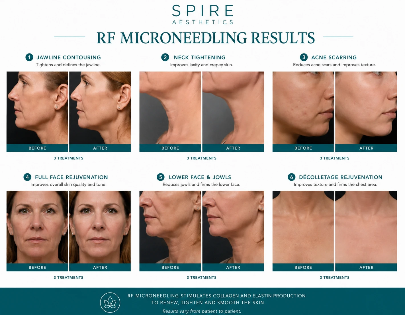 RF Microneedling Skin tightening Harlow results