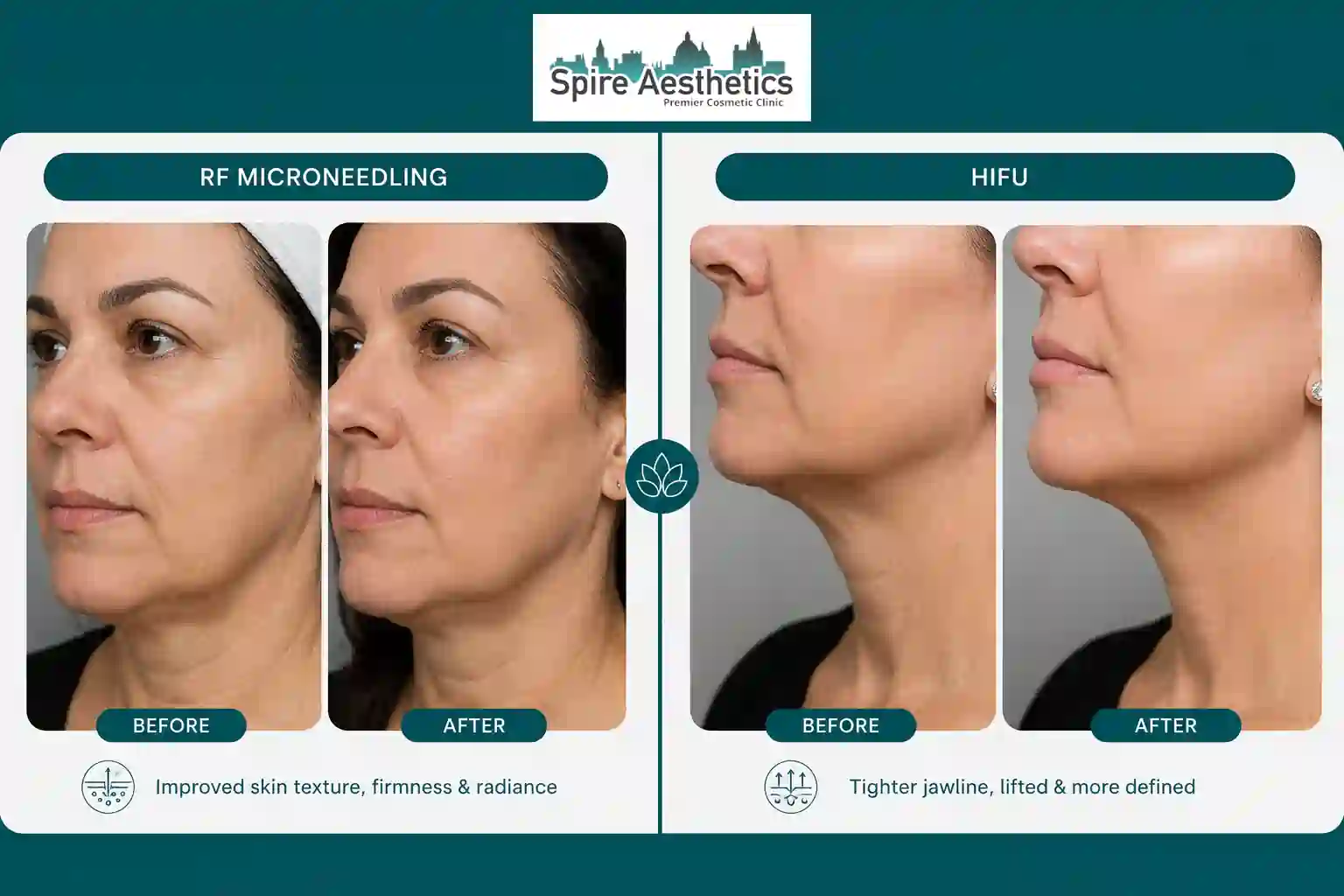 Can RF Microneedling and HIFU Be Combined Harlow?