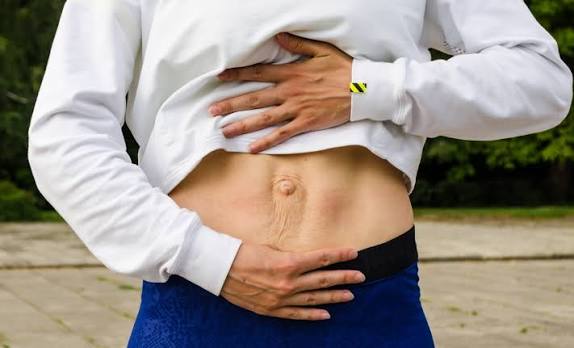 When Could Diastasis Recti Be the Missing Piece of the Puzzle Harlow?