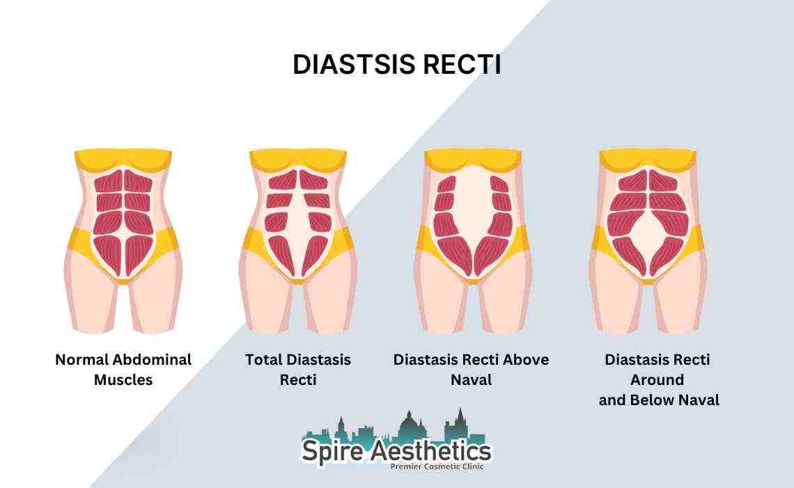 Is Non-Surgical Diastasis Recti Treatment Right for You? Common Concerns Answered Harlow